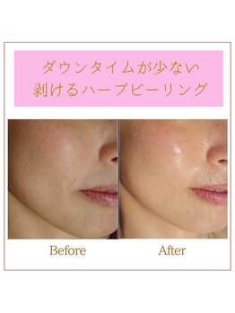 ココロ(COCORO)/剥けるハーブピーリング 3回