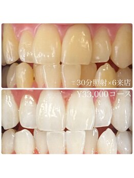 ホワイトニングルーム 横浜店(Whitening Room)/ホワイトニング/横浜