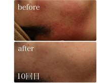 ベビースキン(baby skin)/赤ら顔改善