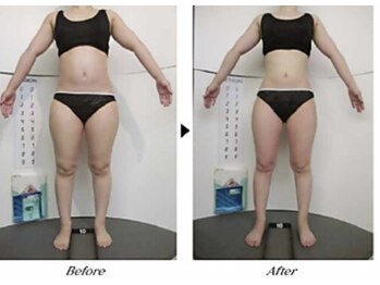 ビューティークリニックコダマ 宮崎本店/【1か月コース】Y.H様（27歳）