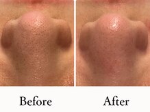 ラシック(La chic)/毛穴洗浄/ララピール心斎橋大阪