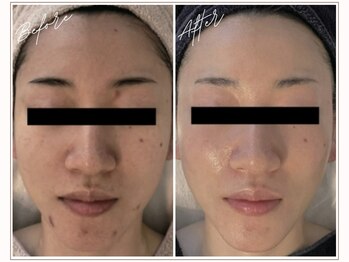 ミューベル(MYubelle)/水光肌に♪ 水光ピーリング