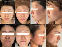 スマイルビューティラボ(Smile Beauty lab.)の雰囲気（お顔ハーブピーリング☆Before /After）