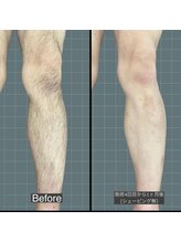 アレッド 大阪店(ared.)/脱毛をして自信がつく！