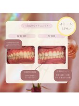 プラスビーセルフ(+b self)/ホワイトニングビフォーアフター