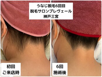 プレヴェール 神戸三宮/うなじ脱毛