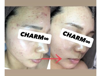 チャーム(CHARM∞)