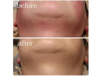 ベビースキン(baby skin)/赤ら顔改善