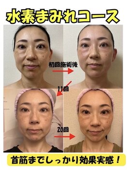 ヨサパーク ア モード ミオ 柴又店(YOSA PARK A modo mio)の写真/気になる顎のたるみも改善！むくみすっきり、お肌を内側から整えながら、輪郭美人に☆