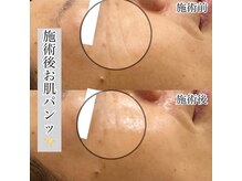 ぺルラ 島田駅前店(Perla)/光フェイシャル