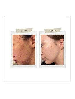 インディバケアプラチナム 横浜店/インディバ施術