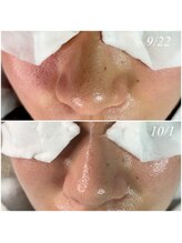 レイ(Rey)/毛穴洗浄＆セルマン