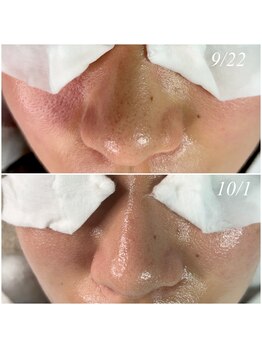 レイ(Rey)/毛穴洗浄＆セルマン