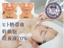イーズスリミングプロ 横浜コレットマーレ店/ヒト臍帯血幹細胞培養液導入