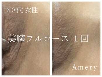 アメリー(Amery)/Before After