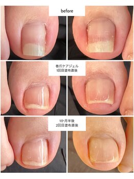 ケアプラス(care plus)/巻爪ケアジェル