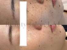 エルアンドエル(L&L)の雰囲気(3回でここまで変化!(個人差あり)目指せノーファンデ生活☆)