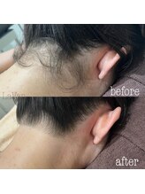 ラヴァン(LaVan)/うなじ脱毛