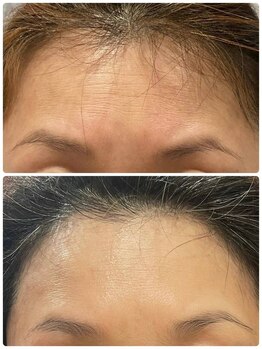 ハッテンビューティーパーク 神戸店(Hatten Beauty Park 810)/【ナノBirodo水光】