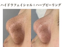 ル ポム バイ ティアム 神戸元町(Le pom by TIAM)/最強毛穴セットメニュー☆