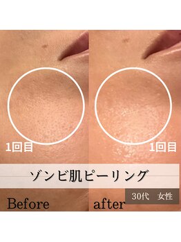 パルティノ 高崎店/ゾンビ肌ピーリング