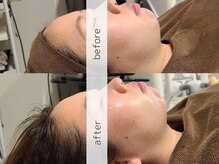 ブラン(BLANC)/サーマルフラクショナル