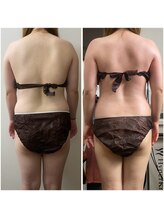 ポラリス(Polaris)/シェイプビフォーアフター