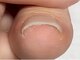 ラグ(RAG)の写真/放置していた巻き爪を解消するには当サロンへ！資格を持つスタッフがしっかりサポートします。当日受付OK