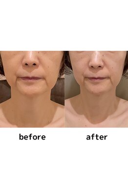 シエル(Ciel)/首も細く、ほうれい線も薄く！