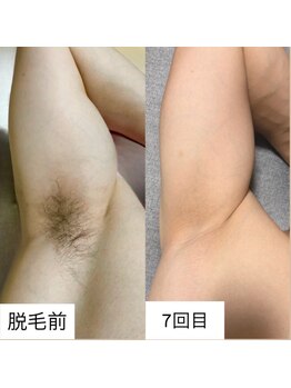 クレエ(Cre’er)/メンズ脱毛☆