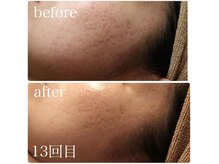 ベビースキン(baby skin)/肌改善