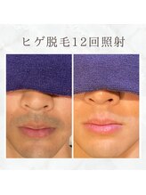 ボゴス(BOGOSS)/ヒゲ脱毛12回照射