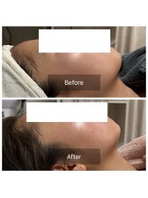 カノン(Kanon)/レモンボトルと美白ケア1回目