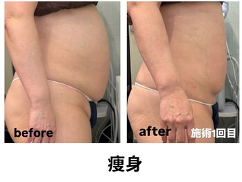 ビューティーサロン リリー(Lily)/痩身プレミアム