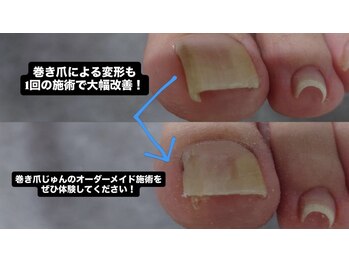 巻き爪じゅん 船橋店/巻き爪による変形1回で大幅改善