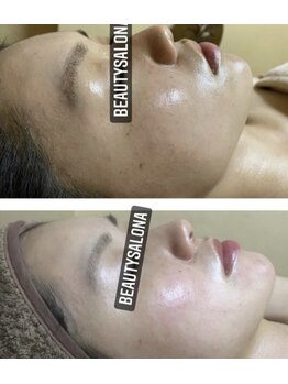 ビューティーサロン エー(A)/ハーブ　＜ビフォーアフター＞