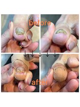 ココリ(CoCoRe)/分厚くなった爪