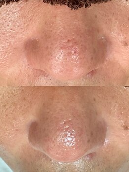 エクラ バイ シャンリィ(eclat by shanLy)/肌質改善コース！