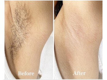 ナナイロサロン ニコリー(NaNairo nicolly)/【ワキW脱毛】ムレニオイ予防◎