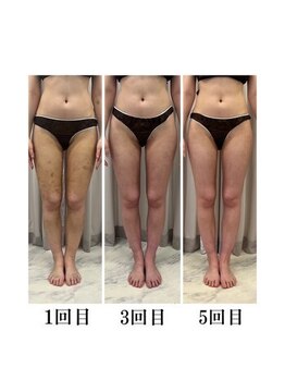 インディバケアプラチナム 横浜店/インディバ施術