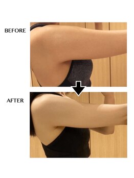 シンシア(sincere)/二の腕★背中/引き締めエステ