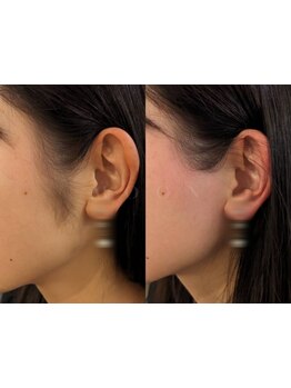 顔脱毛がしたい