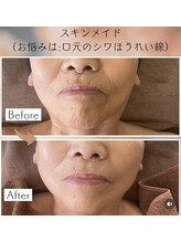 リラクゼーションサロン ラキ(laki)/トロイアルケ　スキンメイド