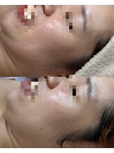 ココリール/シミケア