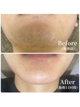 エース(ACE.)/髭脱毛ビフォーアフター☆