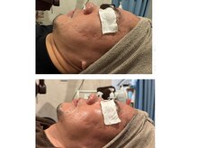 ムルトックスです。ピーリングとリンパケアで小顔効果と肌質改善