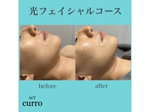 アクト クロ(ACT curro)/【フェイシャルエステ】施術例
