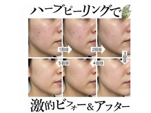 認定講師にお任せ下さい！話題のハーブピーリング☆