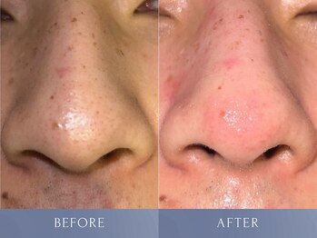 カズキ ハギワラ(Kazuki Hagiwara)/毛穴ケア施術当日ビフォアフ