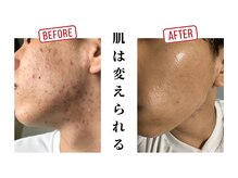 アップデートサロン(UPDATE SALON)の雰囲気（肌悩み多数解決実績有り！！一度、お悩み相談受けてみて下さい）